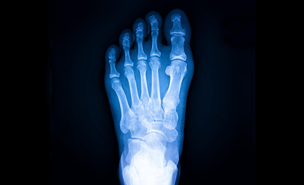 Artículo sobre Tratamiento del Neuroma de Morton ofrecido por Dr. Francisco Castillo Vazquez