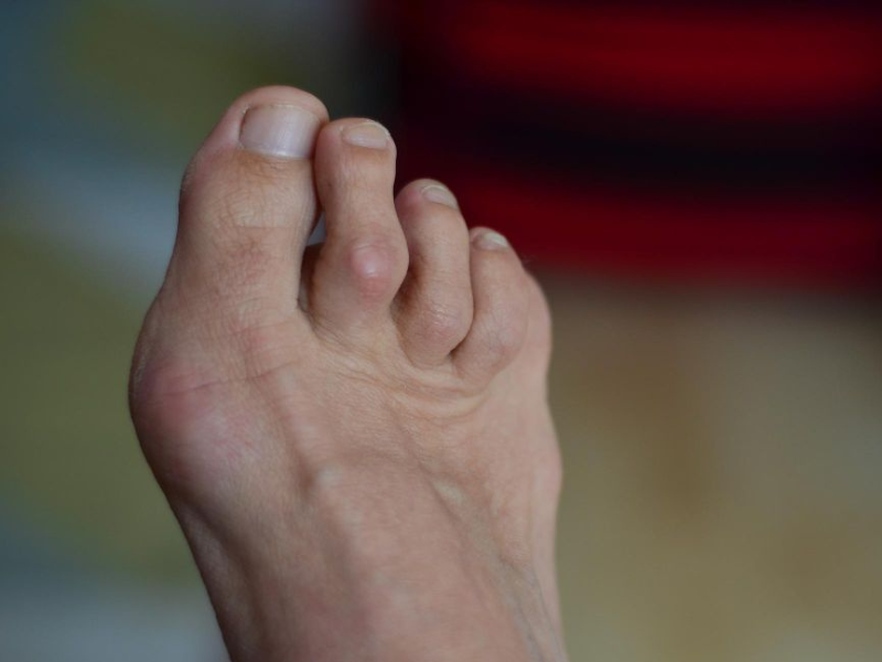 Artículo sobre Tratamiento de Dedos en Garra ofrecido por Dr. Francisco Castillo Vazquez