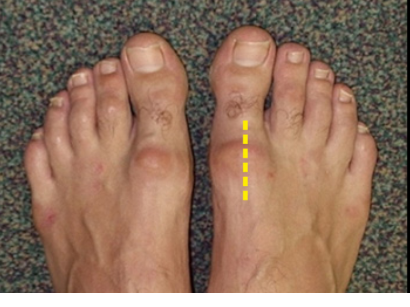 Artículo sobre Tratamiento Integral del Hallux Rigidus ofrecido por Dr. Francisco Castillo Vazquez